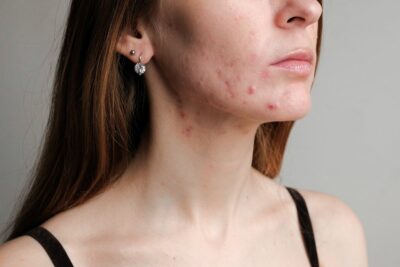 Mindful Choices Sustainable Approaches To Acne Scar Removal