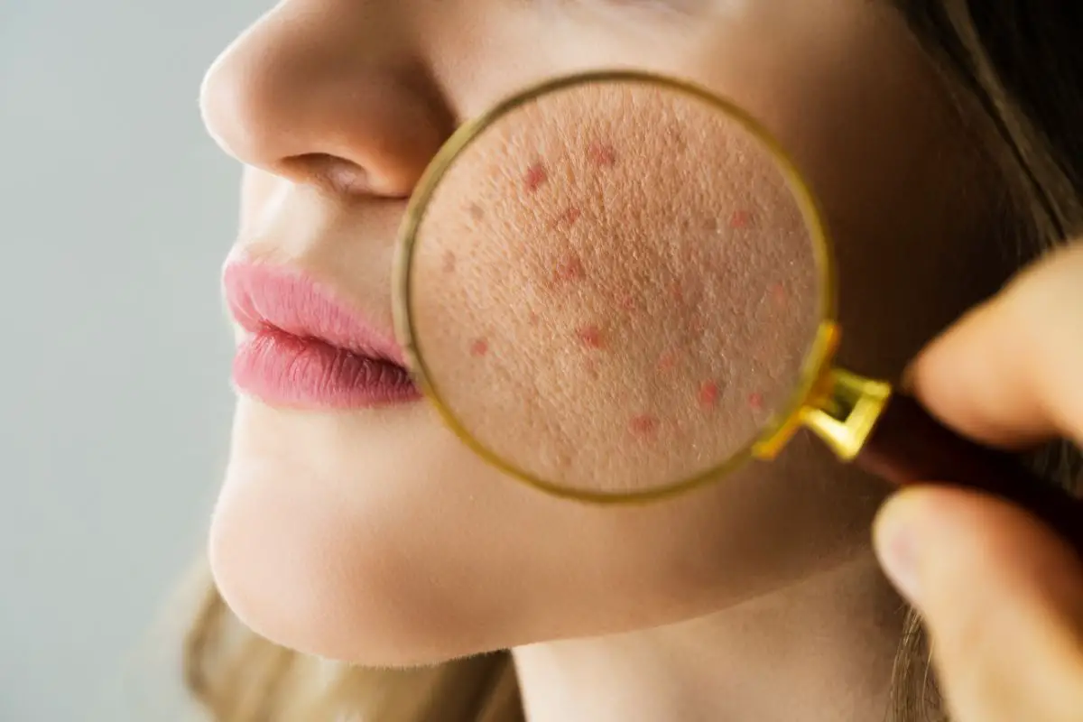 Dermatologist Checking Woman's Acne